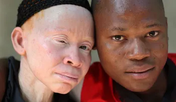 Carnicería humana: el drama de ser albino en África