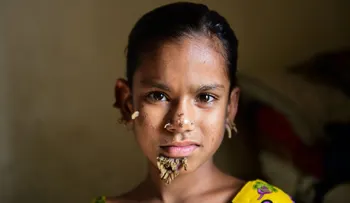Diagnosticaron a la primera "niña árbol" del mundo: impresionantes verrugas con forma de corteza ya comenzaron a crecer en su cuerpo
