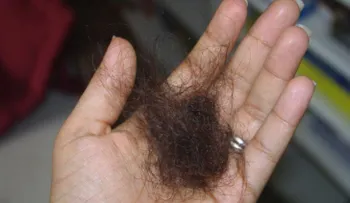 Alopecia una condición que no juzga por sexo u edad 