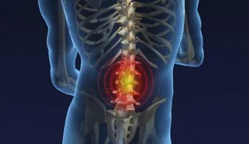 Un disco puede herniarse debido a varias razones