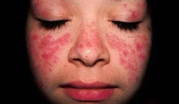 Tratar los síntomas de lupus a tiempo puede evitar afecte órganos y sistema como el riñón 