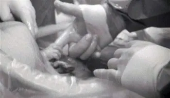 Bebe agarra la mano del médico durante el parto por cesárea