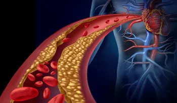 Cómo limpiar las arterias