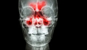 ¿En qué consiste la sinusitis maxilar y cuál es su tratamiento ?