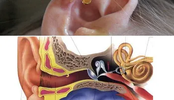 10 remedios que te resuelven el exceso de cera del oído