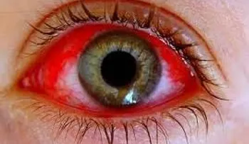 Atribuyen a las lluvias, brote de conjuntivitis afecta el país; muchos niños y adultos afectados 