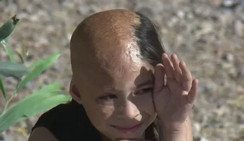 Una niña abandonada por su madre por las quemaduras en su cuerpo