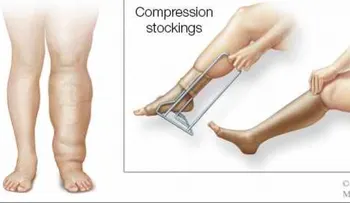 Tratamiento para el linfedema normalmente empieza con vendas y compresión