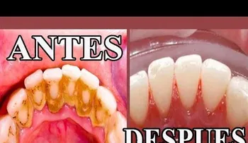 Remedios que FUNCIONAN, para blanquear los dientes!