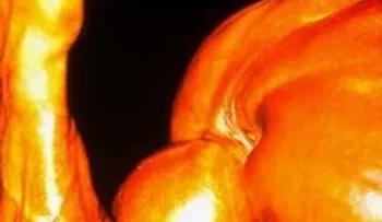 La tendinitis del codo de culturismo