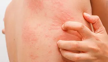 Si tienes urticaria puede estar relacionado a estas enfermedades autoinmunes