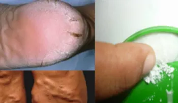 Un milagro: Este remedio cura talones agrietados, callos y las venas varicosas en 10 días