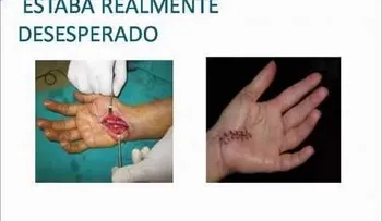 Cura del Sindrome del Tunel Carpiano 100% Natural