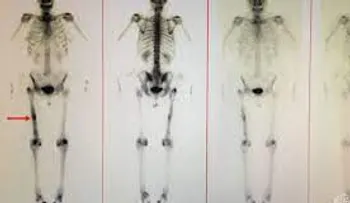 Gammagrafía ósea: Es una prueba de medicina nuclear para detectar posible cáncer en los huesos 