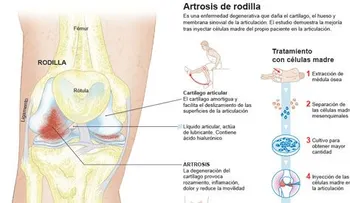 Las células madre para curar la artrosis de rodilla
