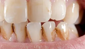 Cómo eliminar el sarro de los dientes naturalmente
