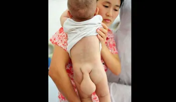 El bebe de 5 meses al que le esta creciendo una cola