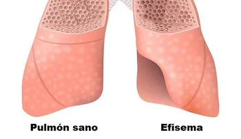 Alimentos que revierten la enfermedad pulmonar obstructiva crónica