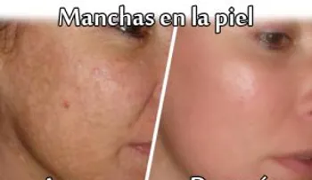 Dile adiós a esta manchas para siempre !!!