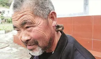 Un hombre lleva 30 años con un â??parásitoâ?? en su cuello