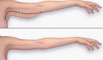 Cómo eliminar la grasa del brazo rápidamente en tu casa sin recurrir a costosas cirugías