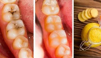 Cure las caries con esta pasta de dientes de gran alcance