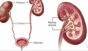 Estudio conecta formación de cálculos renales con enfermedad renal crónica