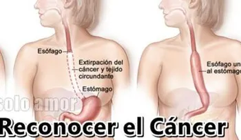 Síntomas de cáncer de estomago: Tiene que ver esto para evitarlo a tiempo