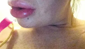 Una mujer se sometió a un tratamiento de relleno de labios y mira como quedó; tuvo que ser hospitalizada