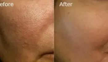 Formas naturales para remover los grandes poros 