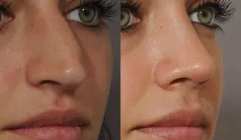Preguntas más frecuentes sobre la rinoplastia