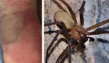 Amputan una pierna a mujer picada por peligrosa araña en EE.UU; la someten a 7 cirugías 