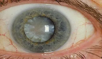 Los científicos desarrollan gotas para los ojos que pueden derretir las cataratas