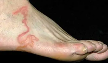 El pensaba que era una vena varicosa, pero los doctores no podian creer lo que había dentro