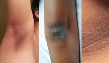Aprende a eliminar las manchas de codo, axilas y cuello en tan solo minutos!