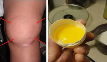 Remedio natural para eliminar el dolor de rodilla y la inflamación en pocos segundos!