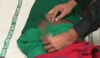Extirpan el rabo de 18 cm de un hombre, el más largo registrado por la medicina