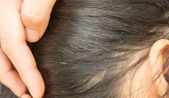Acaba con los piojos para siempre: 10 consejos 