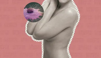 Un gen de células que rodean los tumores, es la clave en avance del cáncer de mama.