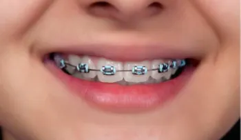 Tips para aliviar el dolor provocado por los brackets