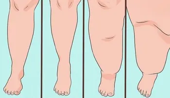 Lipedema ¿Qué es, y cómo saber si la padezco