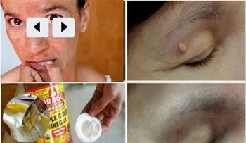 Como eliminar las verrugas, manchas y puntos negros de la piel con rapidez con estos remedios naturales