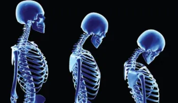 Día mundial de la osteoporosis: 10 consejos para minimizarla