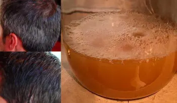 Ya no tengo que usar tinte nunca más. Desde que comencé este tratamiento mi canas desaparecieron por completo