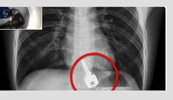 Se tragó las llaves borracho y un médico la encontró en su estómago