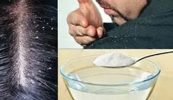 ¿Cómo quitar la caspa con bicarbonato y limón?