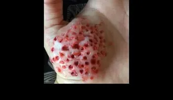 La picadura de este mosquito puede ser mortal y se riesga por el MUNDO (VIDEO)