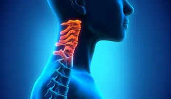 Espondilosis cervical: síntomas y tratamientos naturales