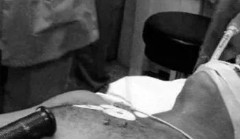 Hombre muere al incrustarsele un pedazo de una pulidora en el pecho 