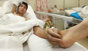 Le implantan una mano en el pie a un chino para mantenerlo con vida